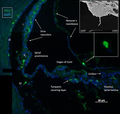 Distribution of Immune Cells Including Macrophages in the Human Cochlea